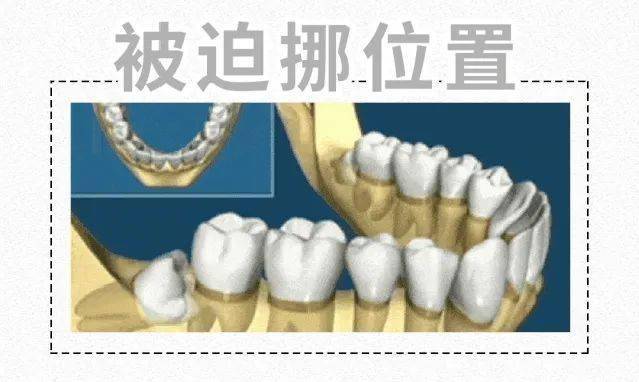 長了智齒該不該拔?這6類人別隨意拔,嚴重時可能危及生命