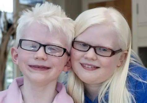 月亮孩子——白化病 |成骨不全症(osteogenesis imperfecta,oi)又称