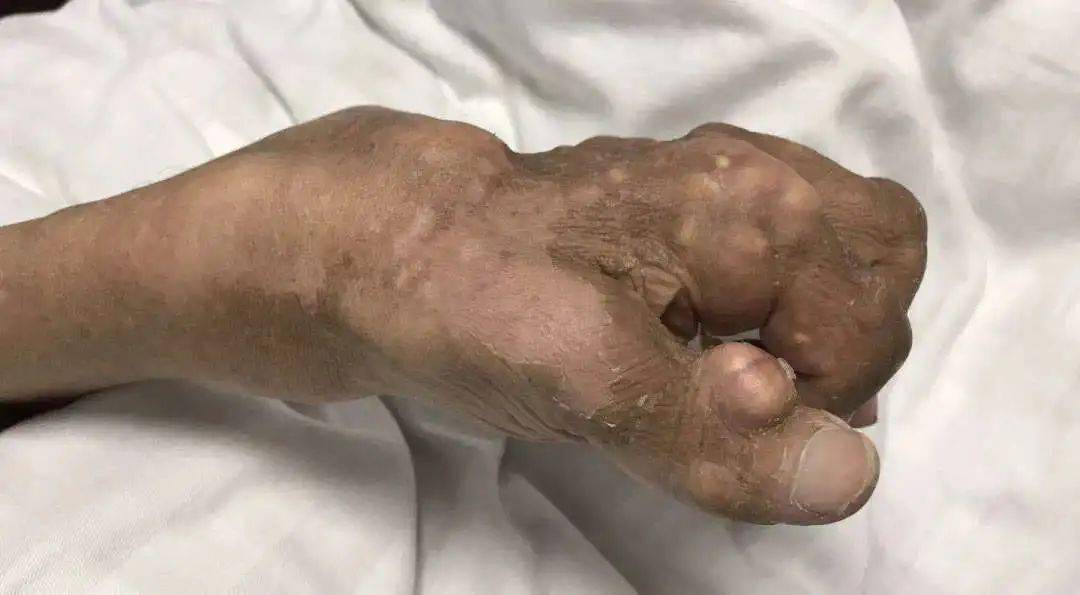 比没有麻醉生孩子还疼这病越来越多年轻人中招