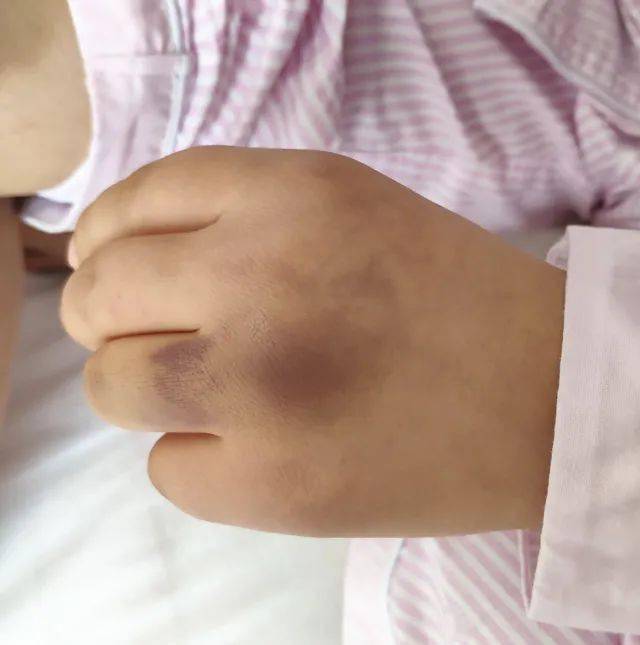 新院区运行花季少女突然鼻子出血身上多处瘀斑千万别大意