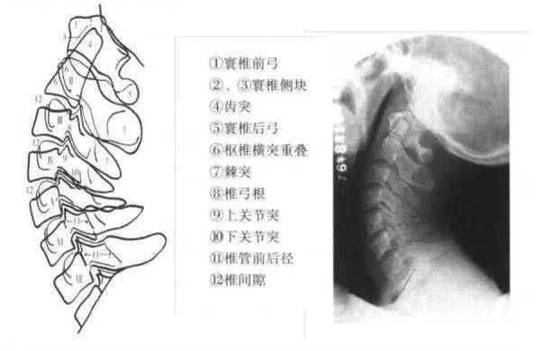 雙側鉤突關節有無增生及其他異常;椎間隙有無變窄及狹窄程度;棘突是否