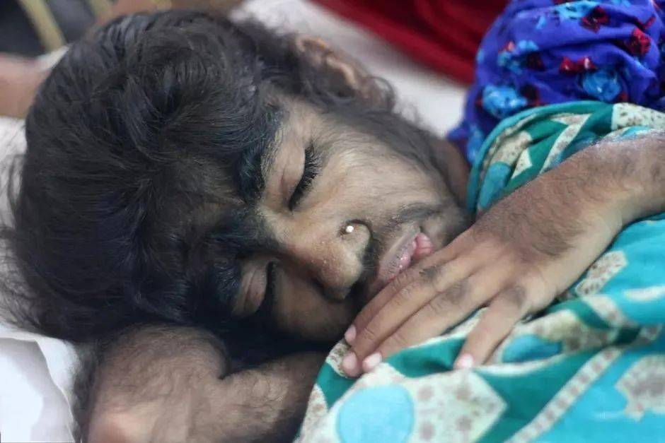 提线木偶人牵线木偶人即多发性硬化症,是中枢神经系统的一种渐进性的