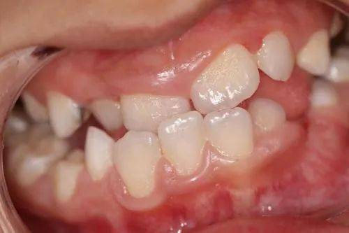 首个人体试验证实新型生物溶液对牙龈炎症安全有效最近的研究