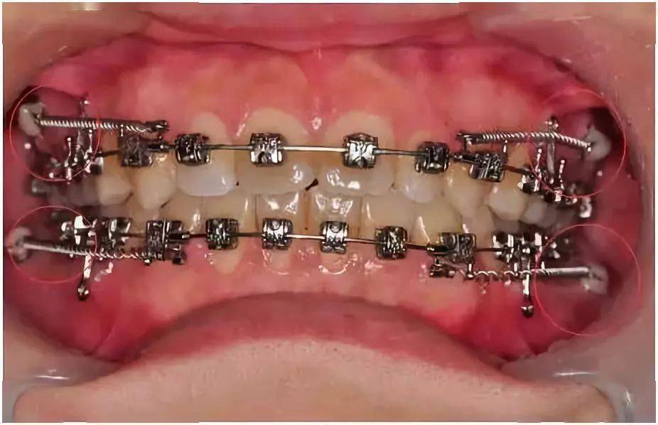 Accelerated Orthodontic Treatment and Wire Sequencing