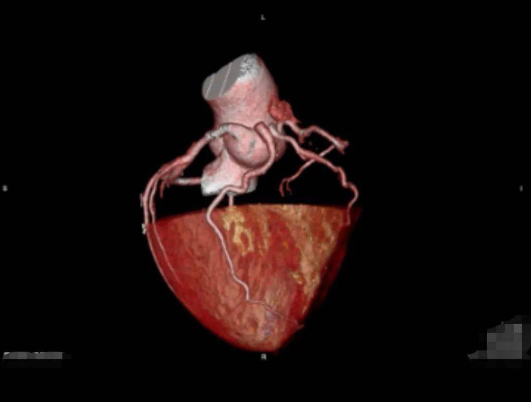冠状动脉窦瘤图片