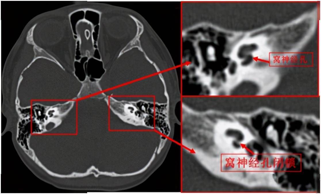 仔细查看扬扬的磁共振及ct影像,发现左侧蜗神经孔闭锁,蜗神经缺如