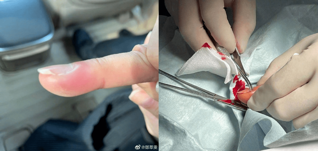 龙川人快住手千万别随便拔手上的倒刺有人因此住院