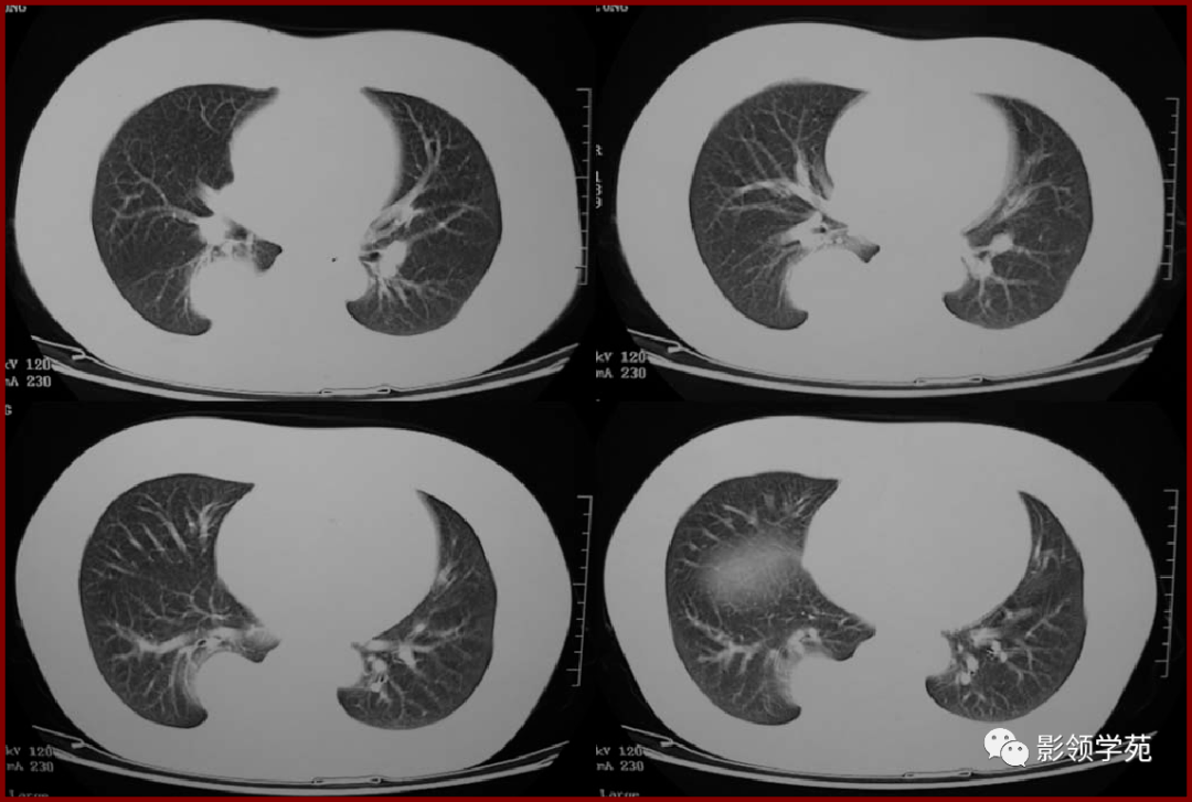 肺良性肿瘤影像表现