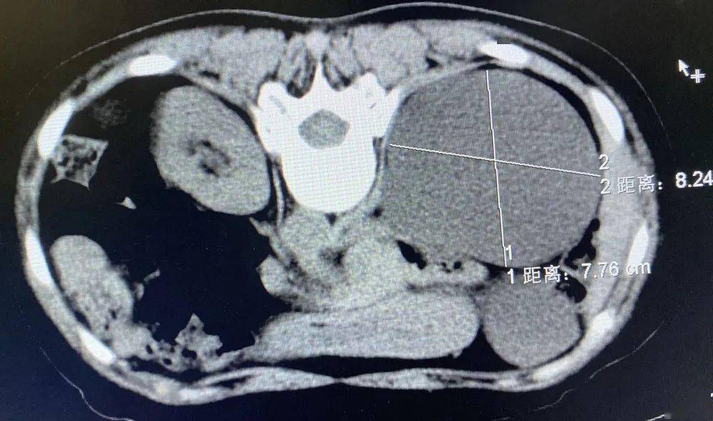 一根針輕鬆解決腎囊腫