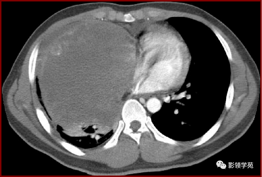 肺良性肿瘤影像表现
