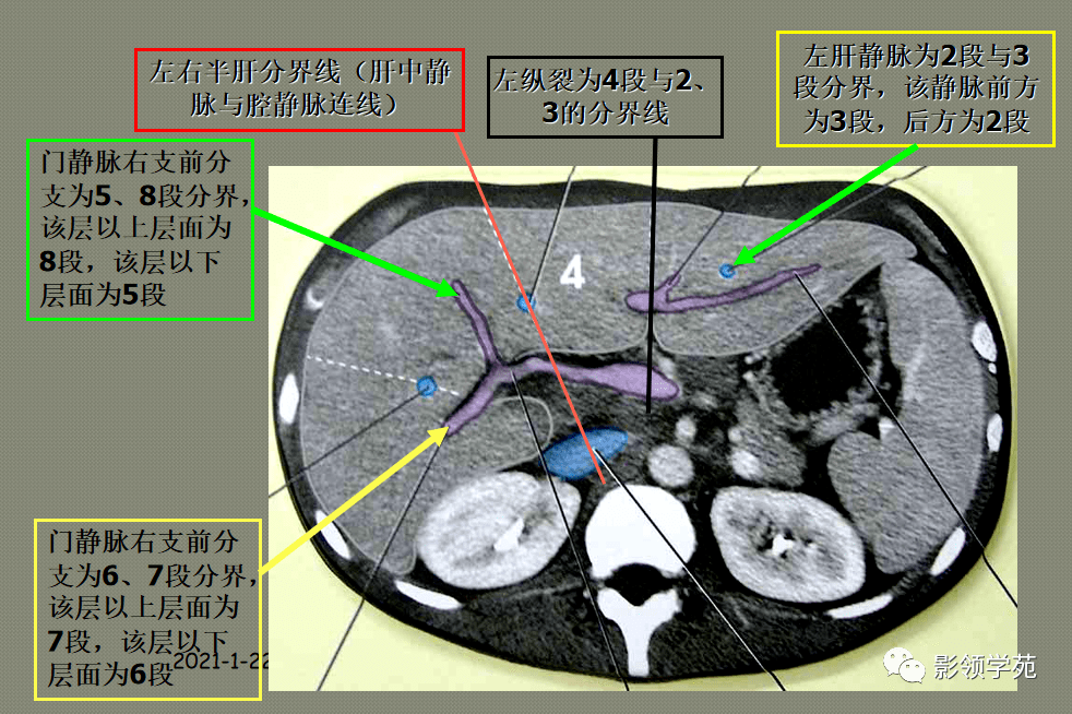 肝脏分叶分段解剖图ct图片