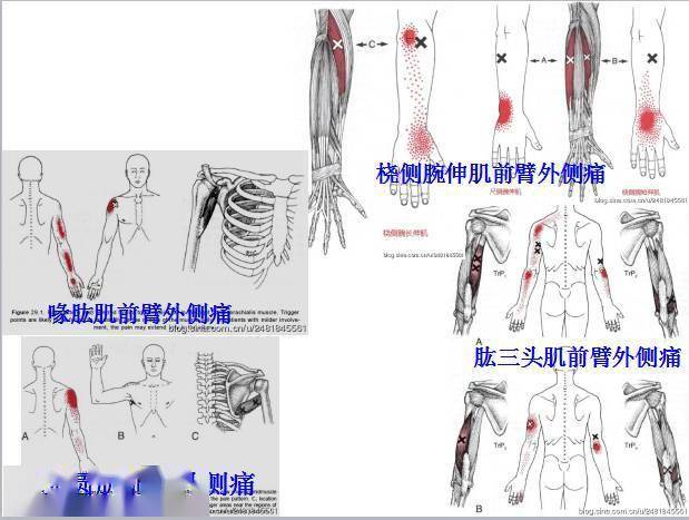 腕和手外側痛主要激痛點橈側腕短伸肌(extensor carpi radialis