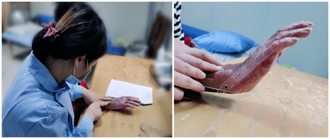 家为灯塔手烧伤患者康复之路