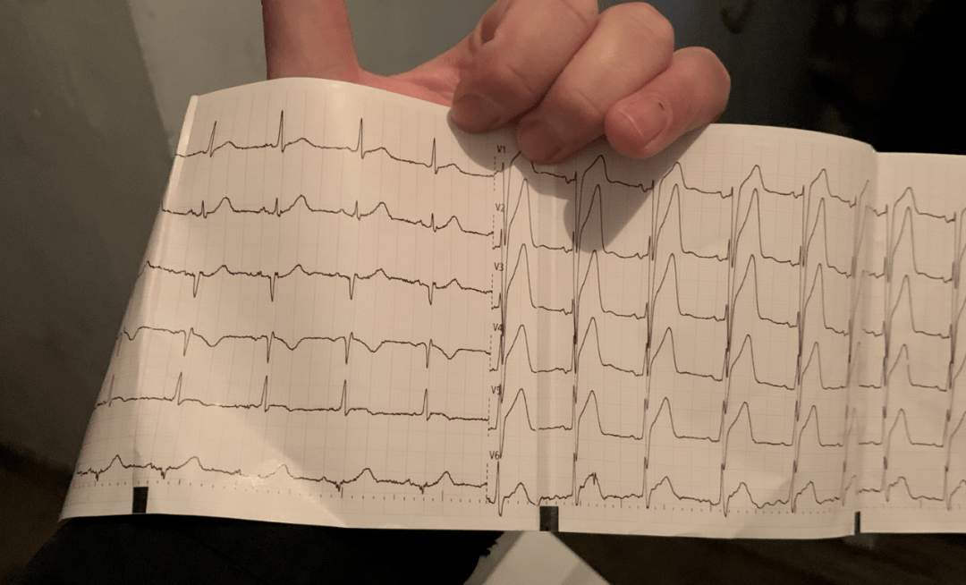 59岁男子多次心梗前兆未重视5点心脏停跳科普心梗前兆
