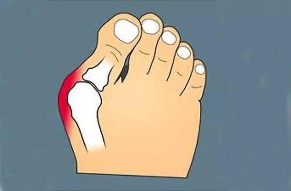 骨科医讯浙大二院骨科曹乐博士常驻本院患有足踝疾病的朋友可以预约啦