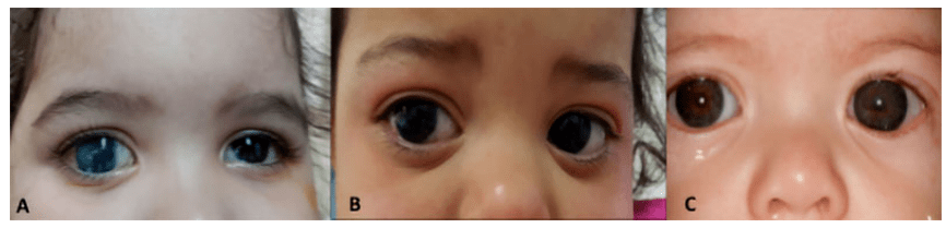 婴儿青光眼图片图片