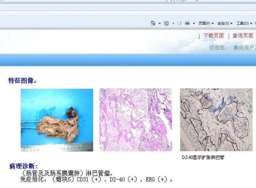 小儿巨大肠系膜淋巴管瘤并肠扭转,肠梗阻 1 例_肠管