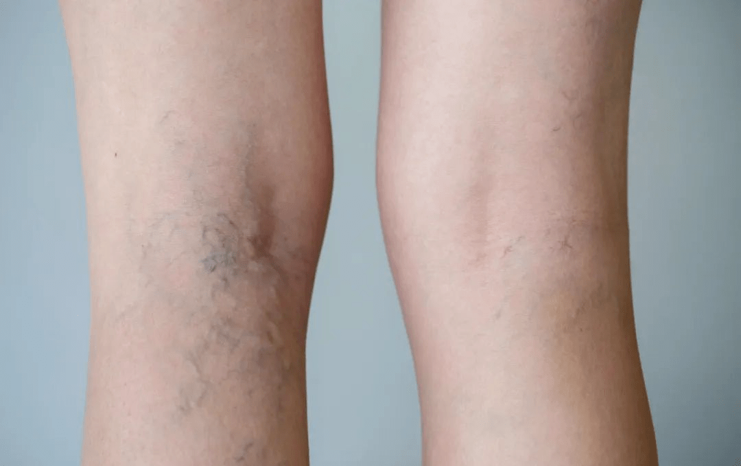 血管堵塞的人一般身体会有4标志要是都没有那偷着乐吧