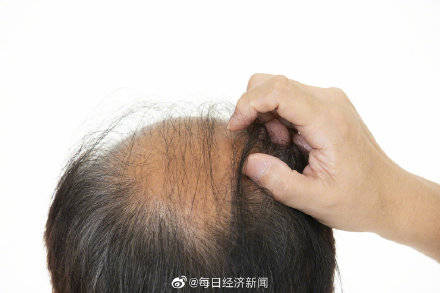真相|脱发真相 ：衰老导致毛囊干细胞分裂异常