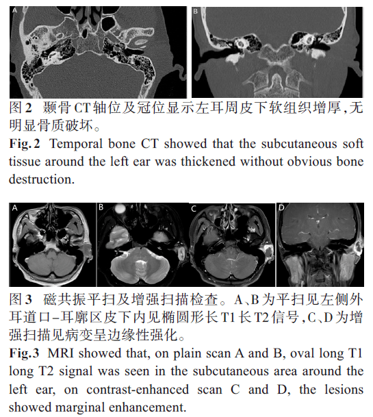 耳部結節性筋膜炎1例並文獻回顧