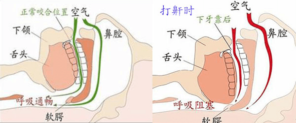 世界睡眠日特輯廈門市中醫院耳鼻喉科開展成人及鼾症檢查治療