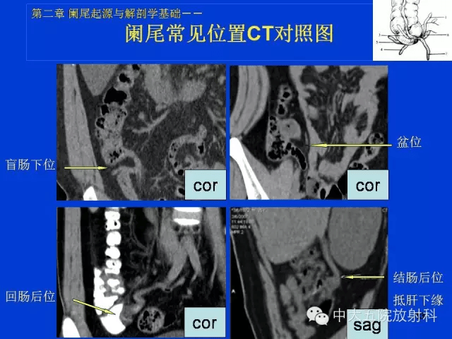 阑尾ct图解图像图片