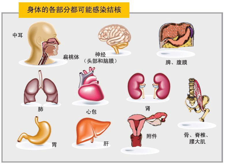 主题为:终结结核流行 自由健康呼吸结核病之肺结核【主要症状】肺结核