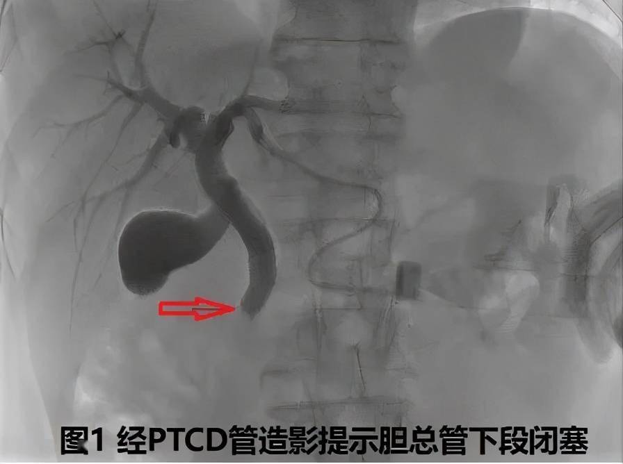 (数字减影血管造影技术)引导下经皮经肝途径胆道钳夹活检术(如下图示)