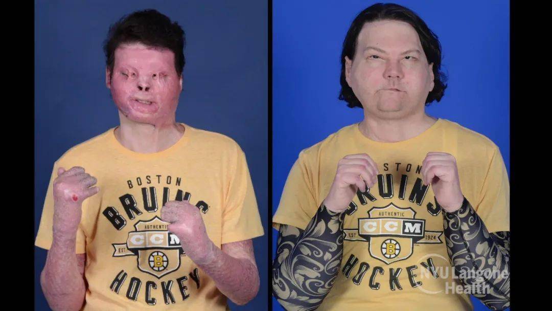 世界首例!脸部 双手联合移植,连续手术 23 小时,一年修复 12 次