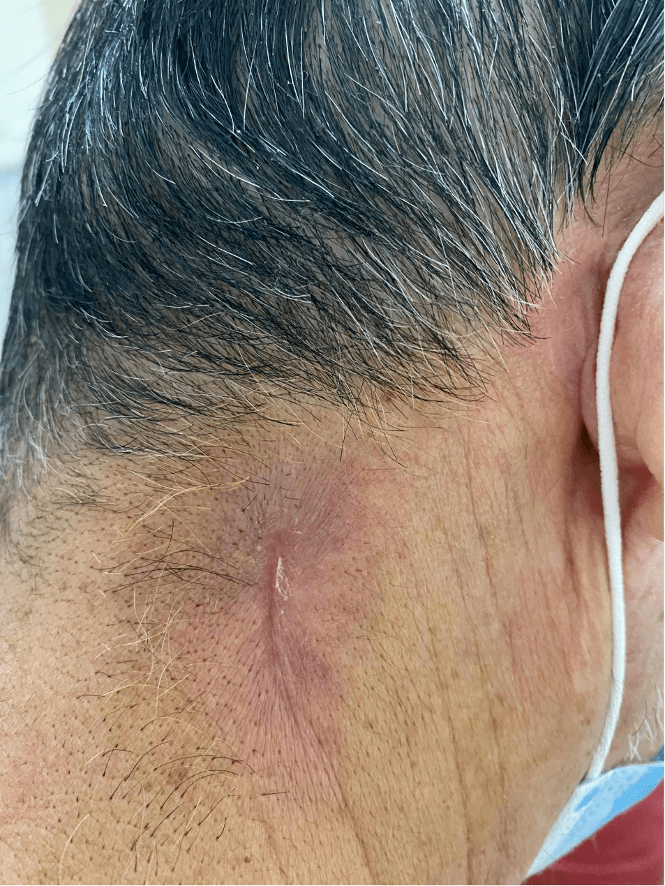 其特点是局部光软无头,红肿疼痛(少数初起皮色不变),结块范围多在6