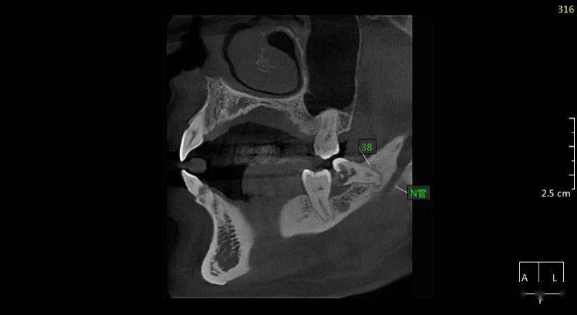 48近中阻生,48双根,牙根紧邻下颌神经管,47龈下龋坏,36远中根折裂