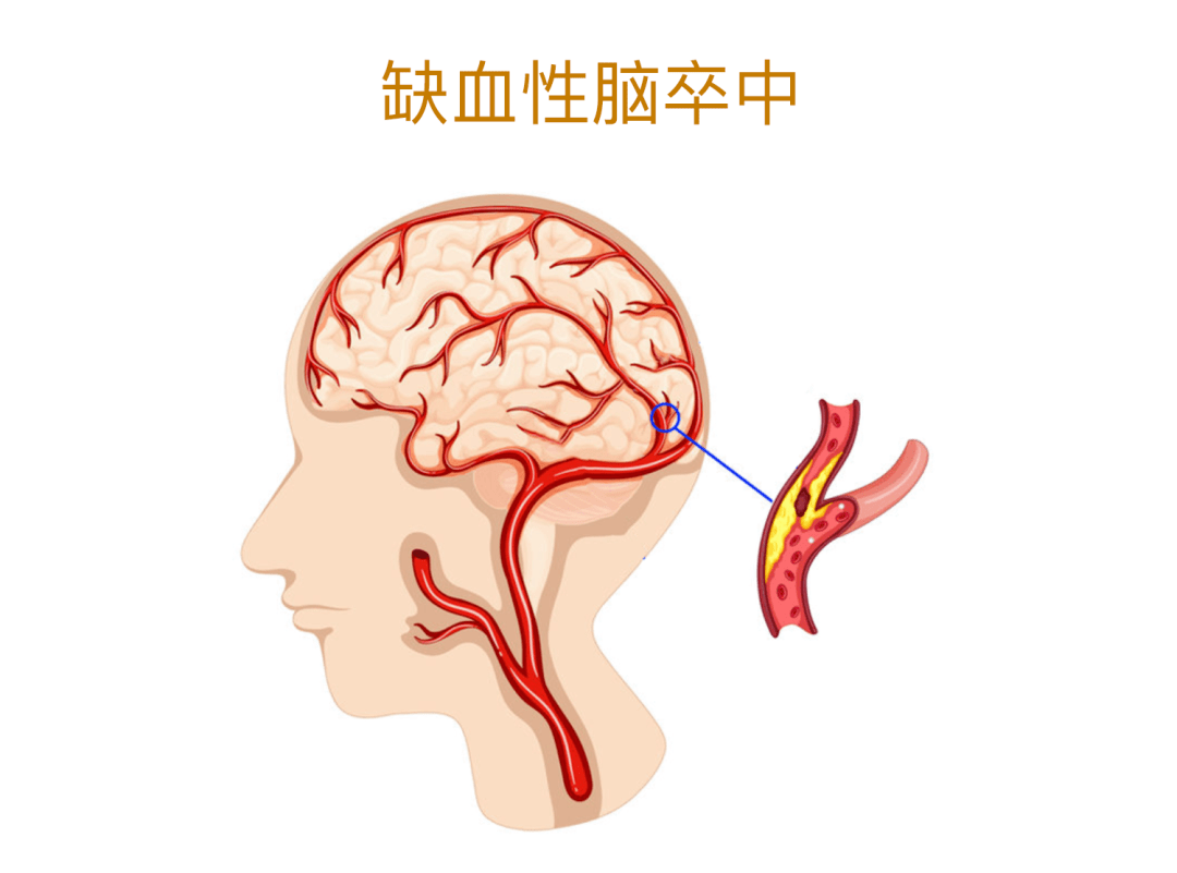 一個週末8個腦梗他們都有一共同特點67神藥安宮牛黃丸到底能不能