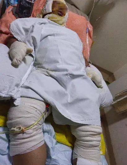 受伤较重 e3ddc009a79443c48def69d5c4db9f17.jpeg