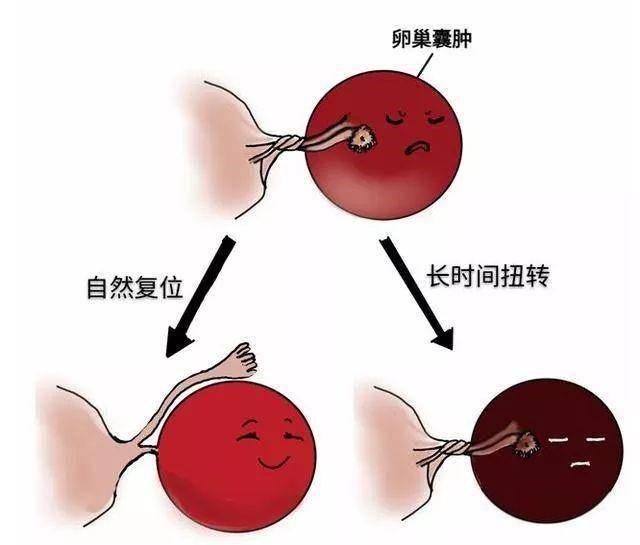 青春期少女突发下腹痛 千万不可轻视 小瞿