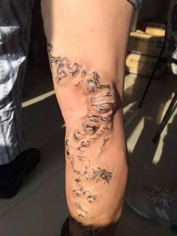 静脉曲张,也就是老百姓常说的"蚯蚓腿",是指由于血液淤滞,静脉管壁