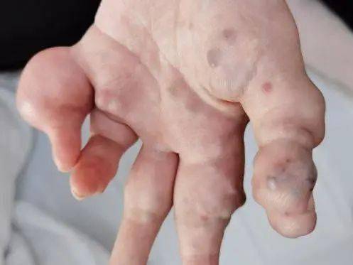 化脓性肉芽肿▲ 淋巴管畸形▲ 动静脉畸形▲ 静脉畸形▲ 毛细血管畸形