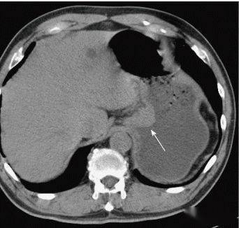 見慣胃腺癌這8種胃腫瘤ct表現你瞭解多少