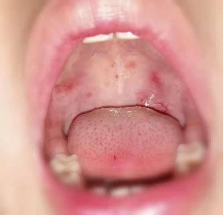 幼儿喉咙有疱疹图片
