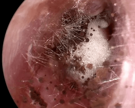 陕西一女子耳朵里竟长"蘑菇"!_女患者