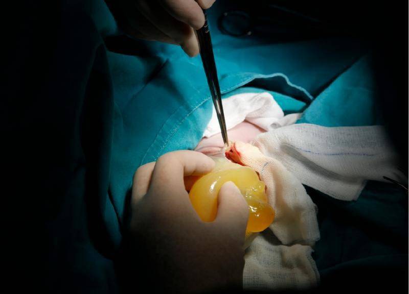 宝宝先天脐膨出,一出生医生为他"补洞塞肝"_手术