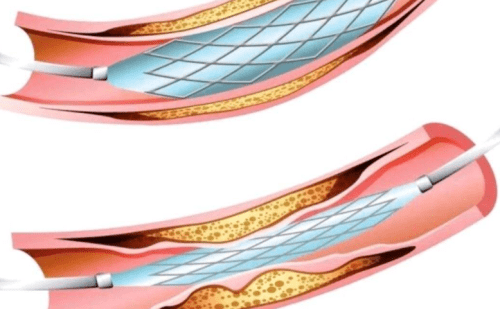 关于冠脉支架的疑问专家这样回复