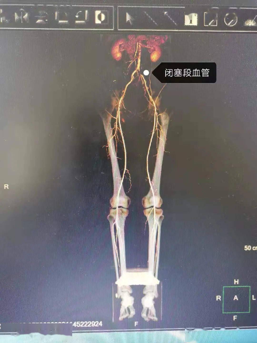 保定第七医院我院普外血管外科治愈一例左髂总动脉闭塞患者