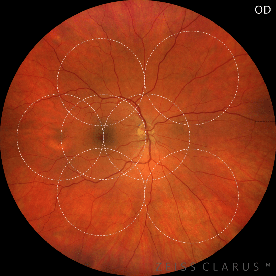 内,clarus 500获取的有效视网膜图像显著优于其他超广角激光扫描检眼