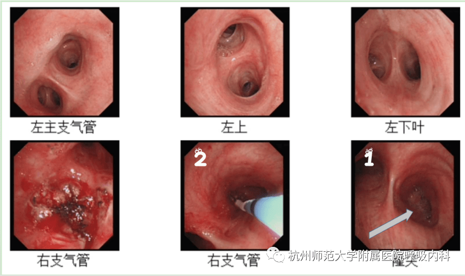 肺穿孔图片肺部图片