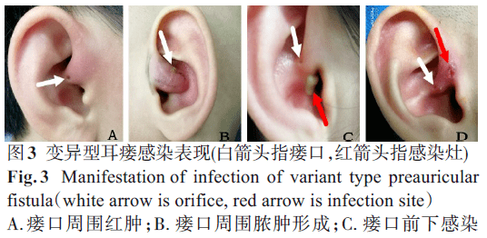 感染耳前瘘管的临床特征和手术治疗