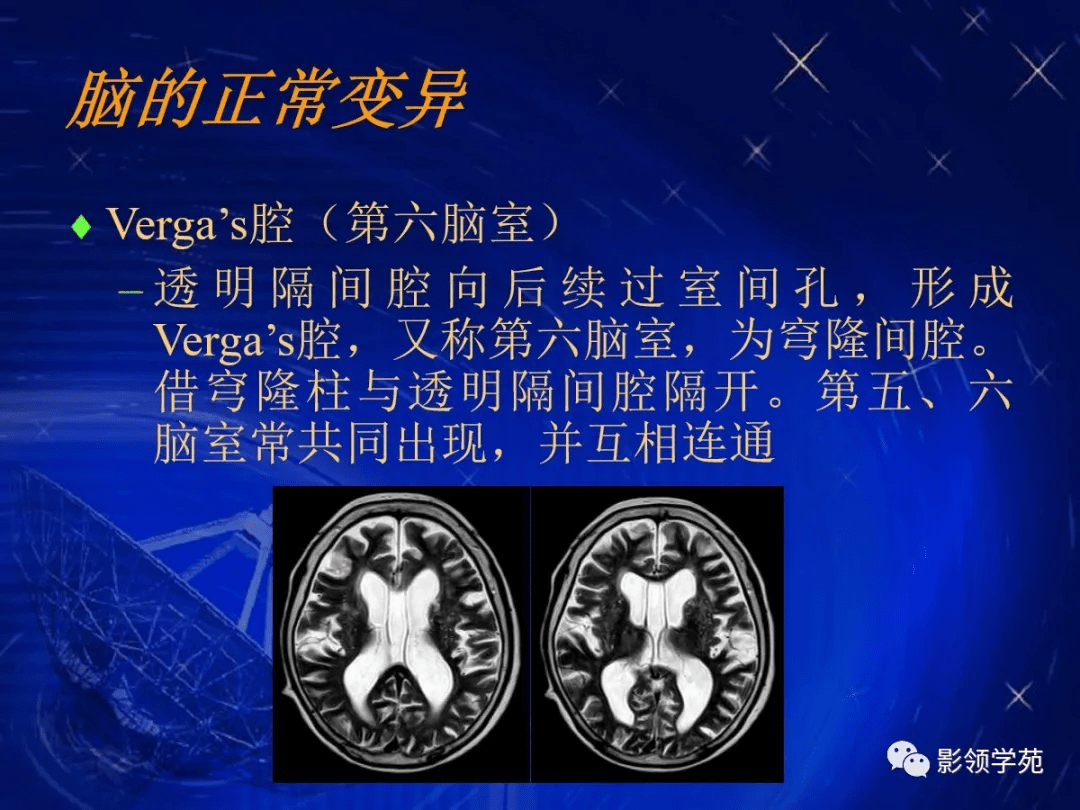 顱腦的影像解剖與常見變異