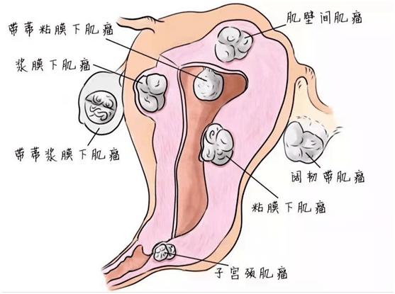 【健康科普】妊娠合并子宫肌瘤,怎么办?