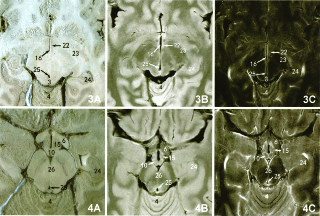 下丘脑核团的全脑磁共振成像与断层解剖对比