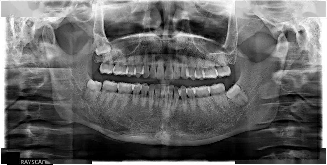 孙xx 20210424 智齿cbct 158xxxx2993