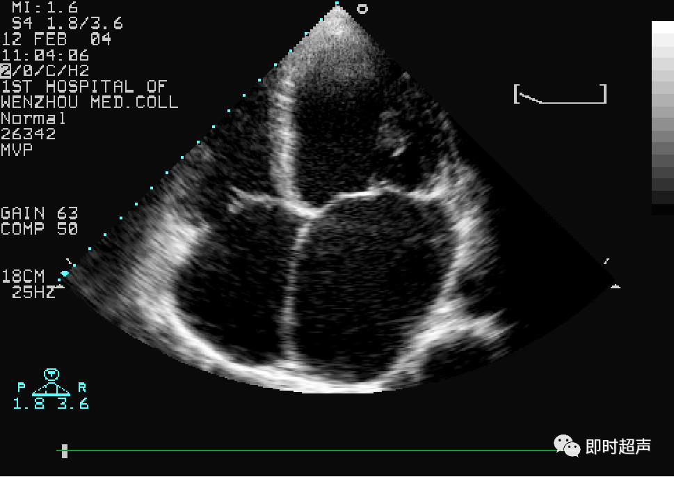 二尖瓣前后叶超声图片